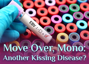 San Antonio dentist Mark J. Williamson DDS talks about a kissing disease you might be less familiar with than mononucleosis.