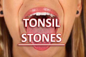 San Antonio dentist, Mark J. Williamson DDS tells patients about what causes tonsil stones and how to treat and prevent them from forming.
